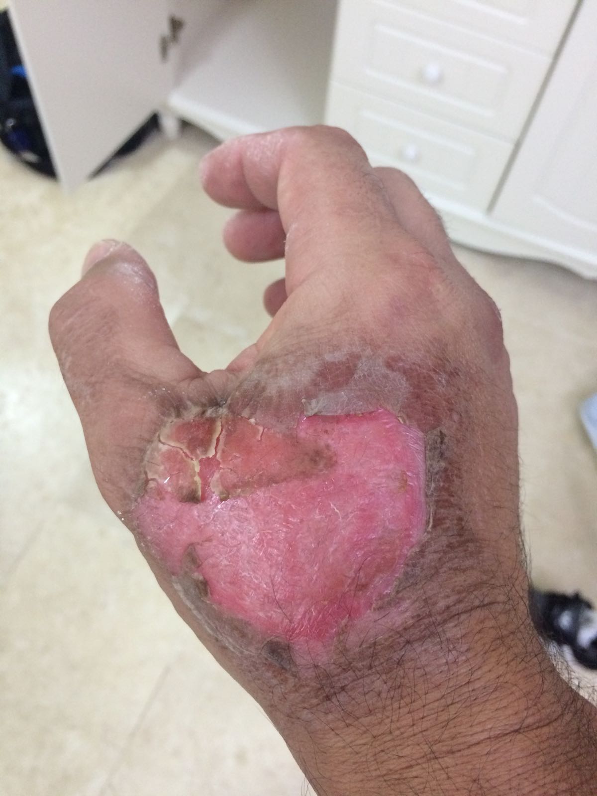 הכוויה של הנהג מונית