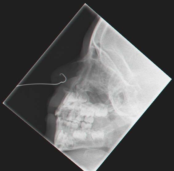 צילום הדמיה צינורית באף