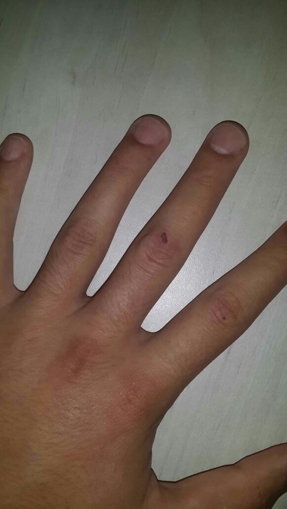 סימן הנשיכה לכאורה. לטענת הקטין /File/50185